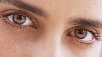 Zehirli Guatr Göz Büyümesi Belirtileri ve Tedavisi Zehirli Guatr Göz Büyümesi Belirtileri ve Tedavisi